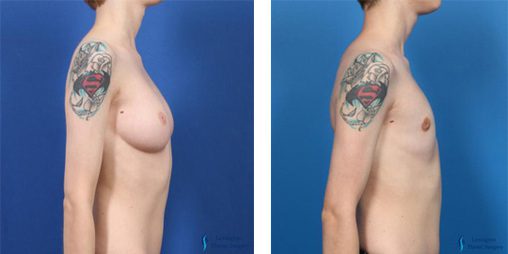 Top Surgery Female To Male: Patient 4