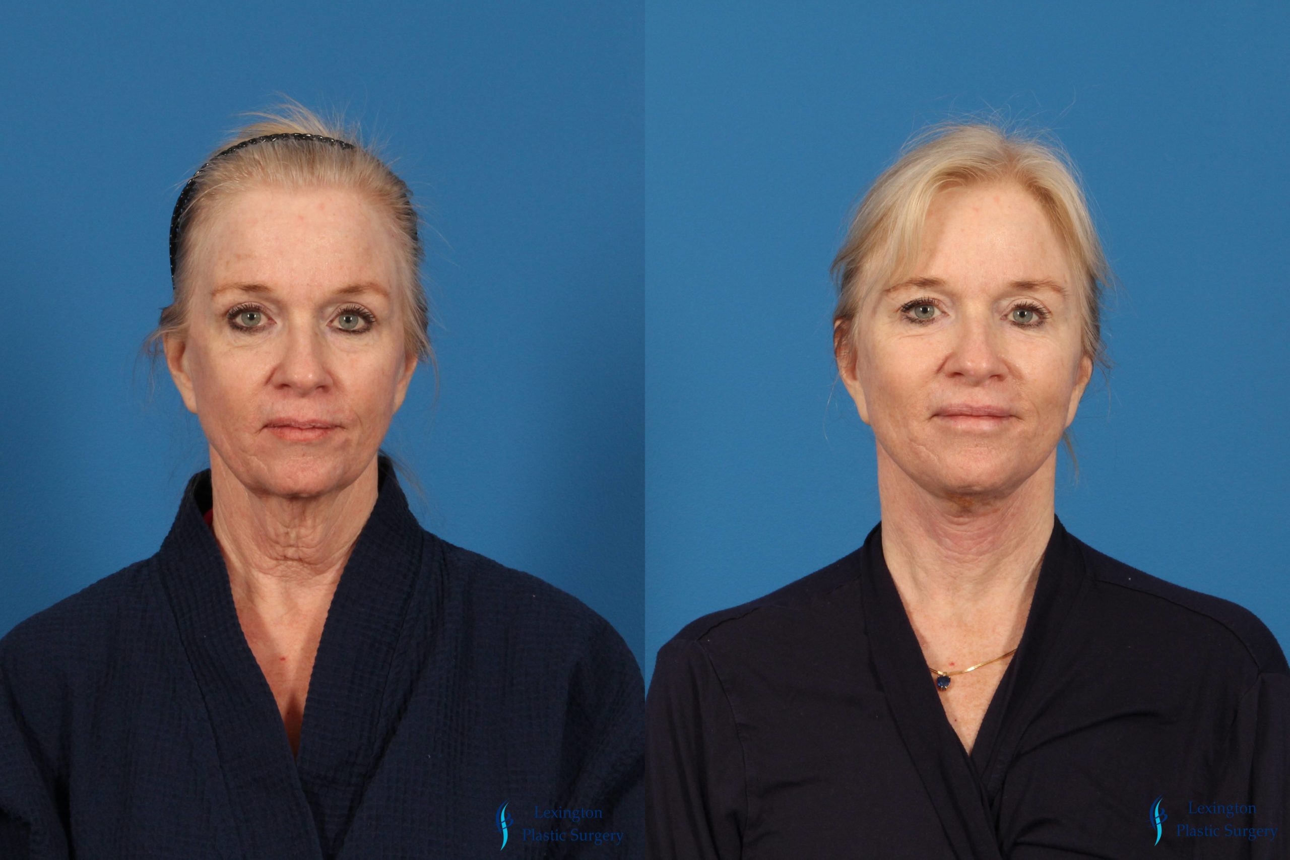 Fat Transfer Face: Patient 4