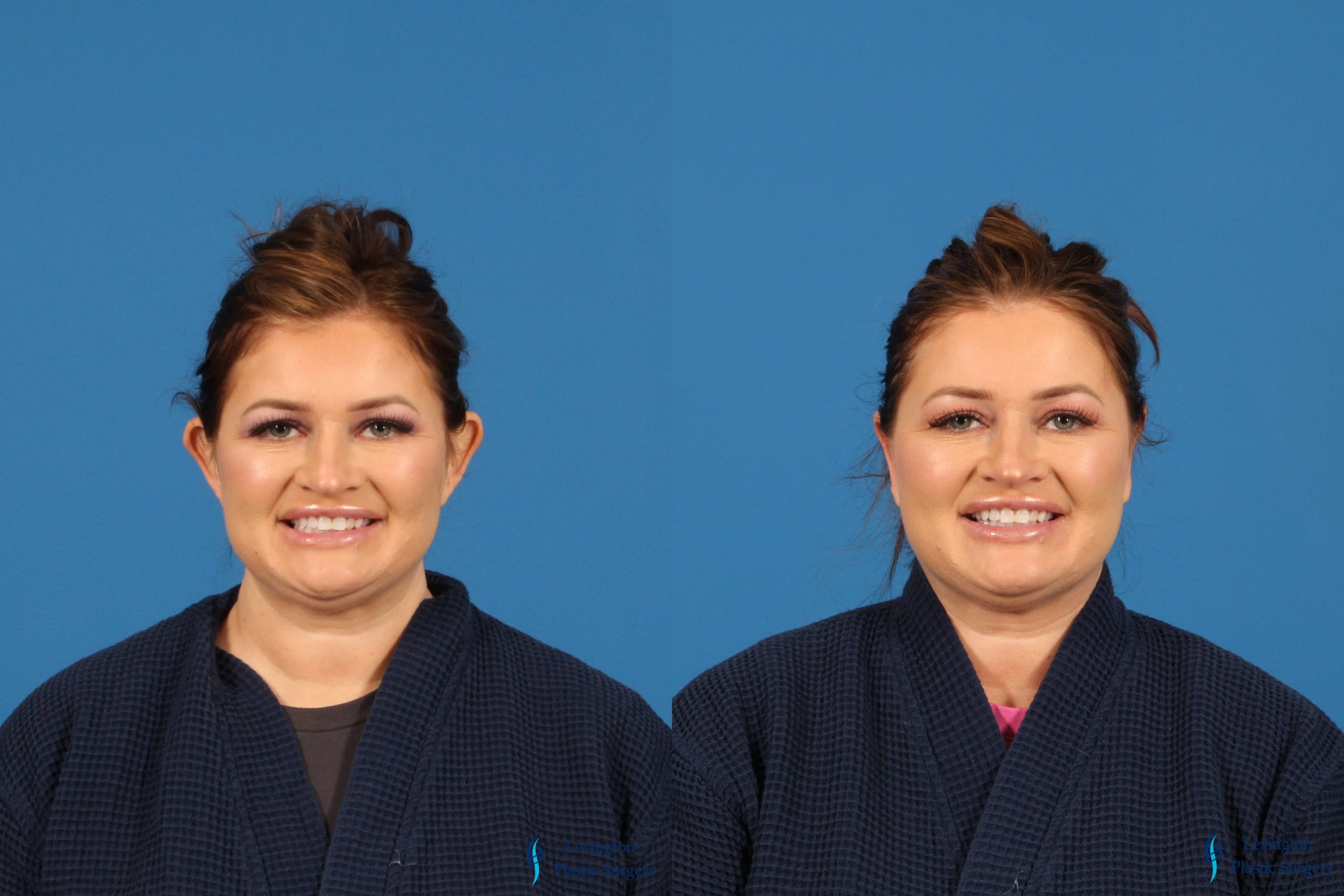 Otoplasty 2 Lexington Plastic Surgery Otoplasty: Patient 5