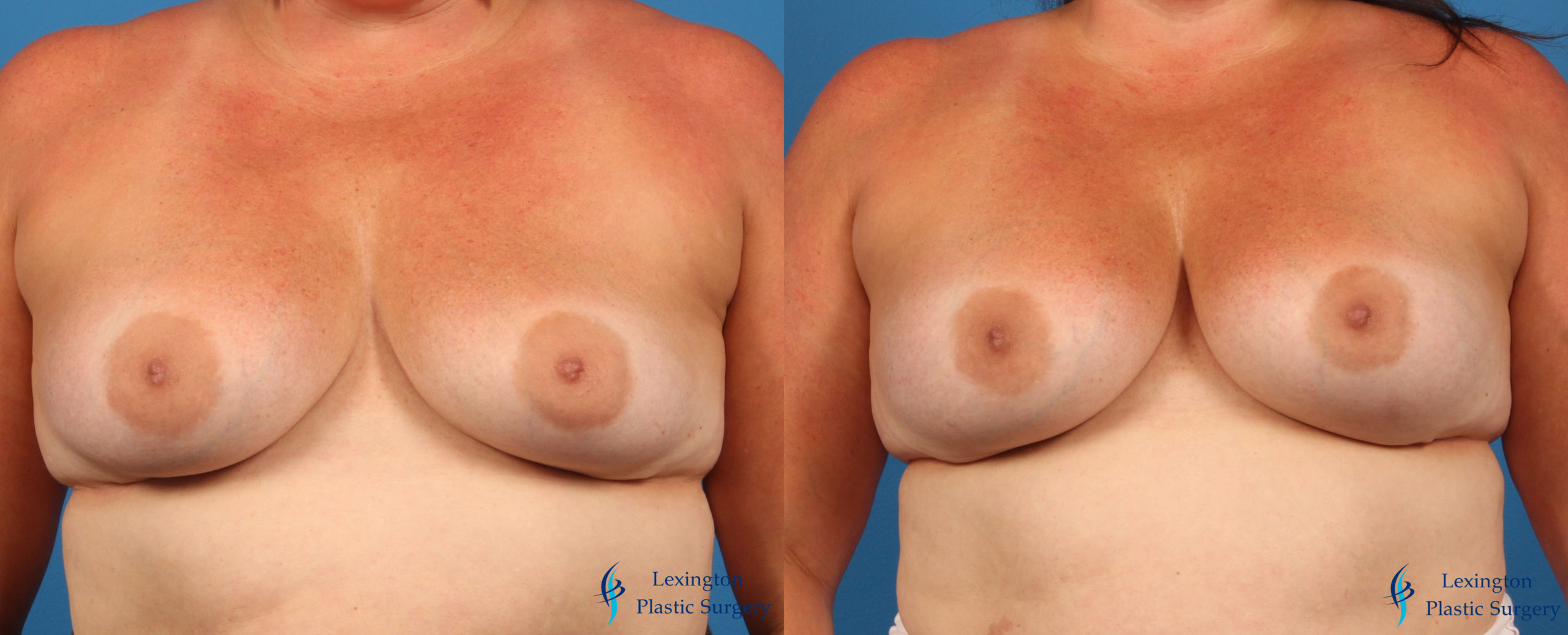 Implant Exchange Patient 4 002 Breast Implant Exchange: Patient 1
