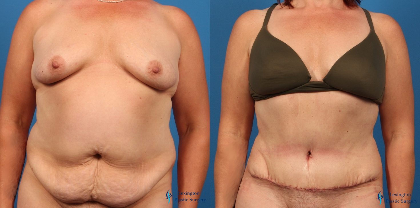 Abdominoplasty Patient 20 Abdominoplasty: Patient 13