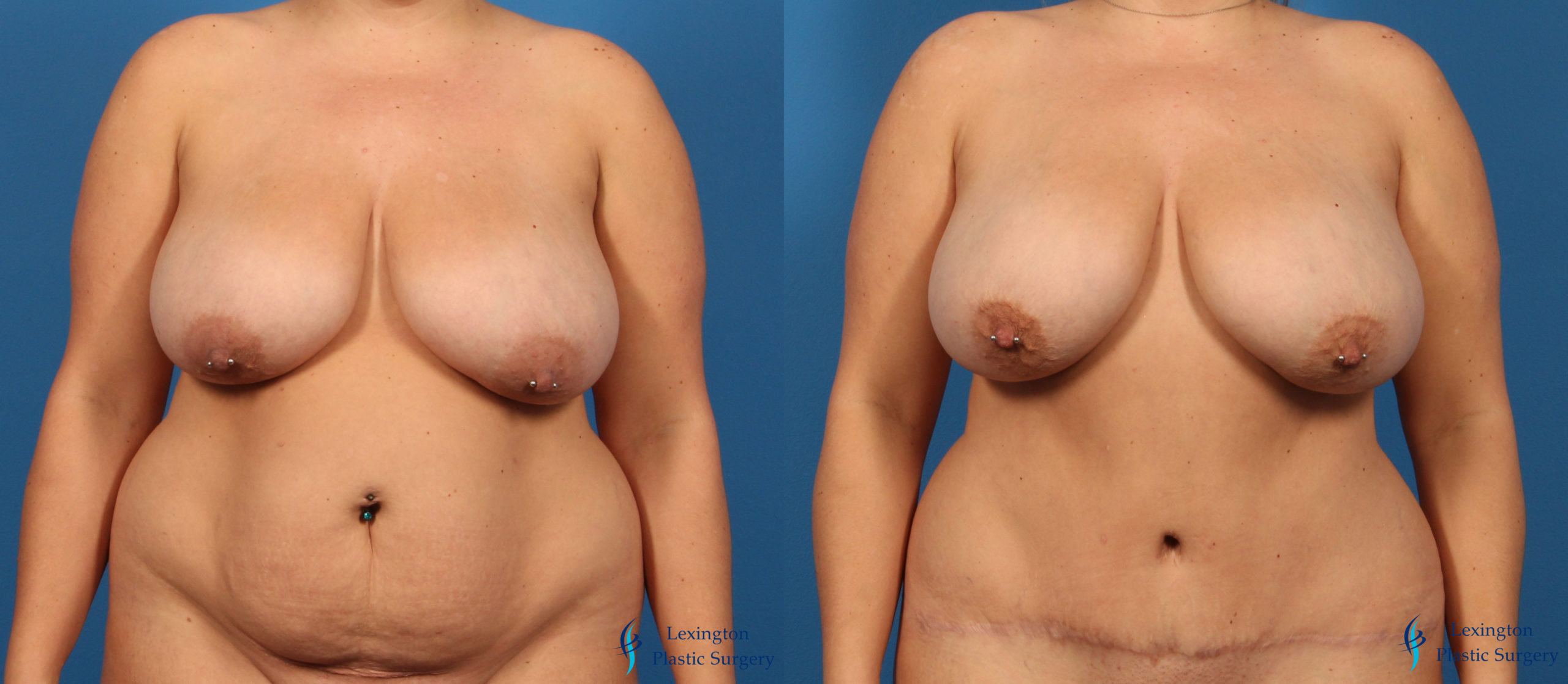 Abdominoplasty Patient 21 (2) Abdominoplasty: Patient 13