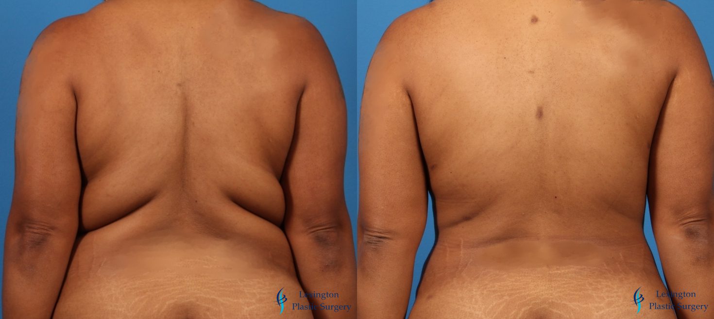 Back Liposuction Liposuction: Patient 3