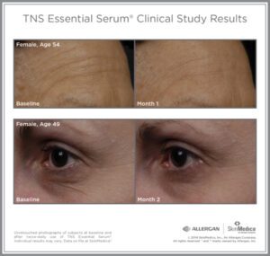 a tns advanced+ serum before and after photo of a 54 year old woman a tns advanced+ serum before and after photo of a 54 year old woman