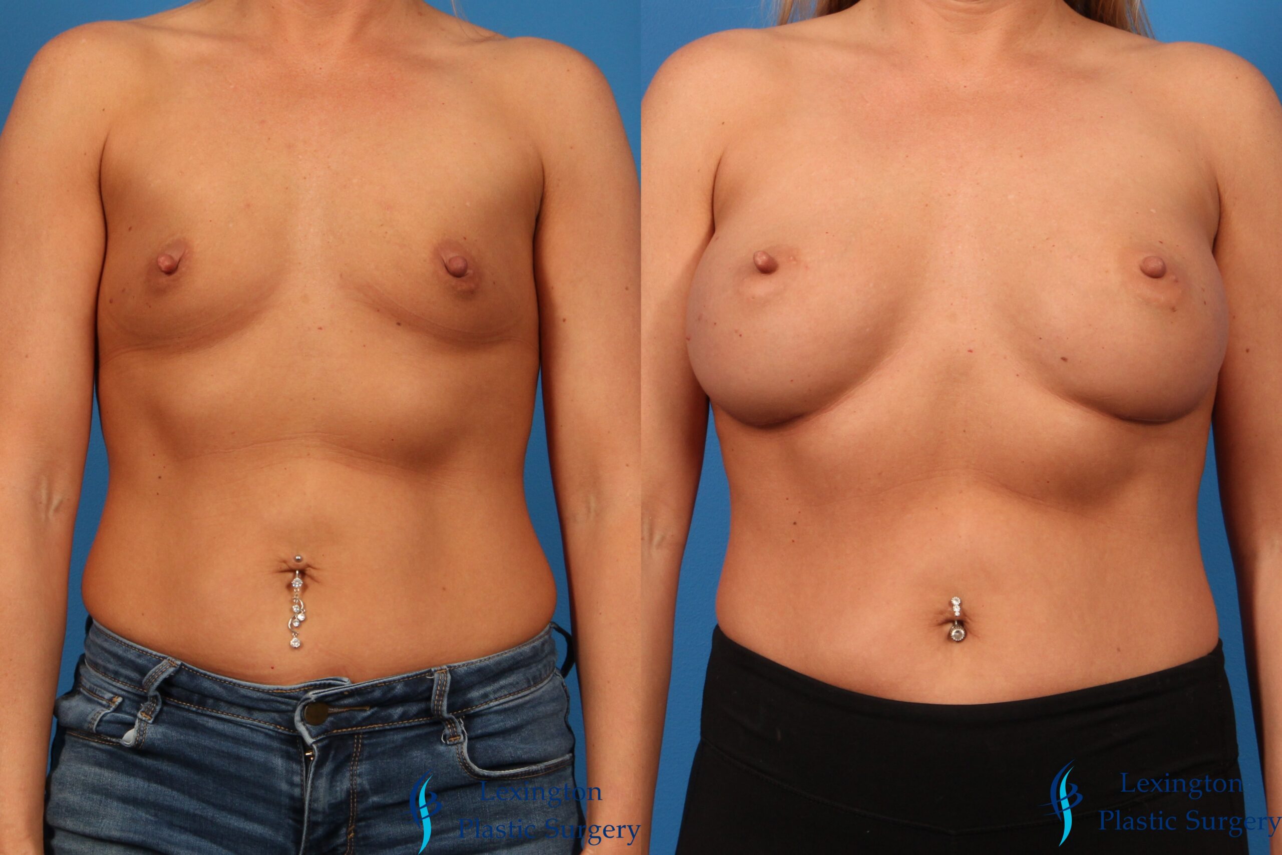 Breast Augmentation 001 Breast Augmentation: Patient 13