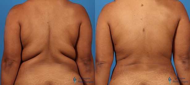 Liposuction
