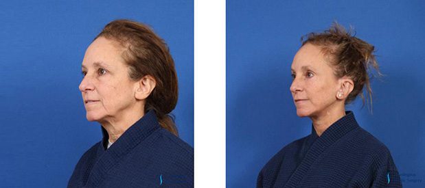 Eyelid Surgery