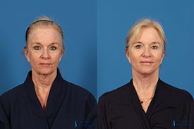 Facial Fat Transfer