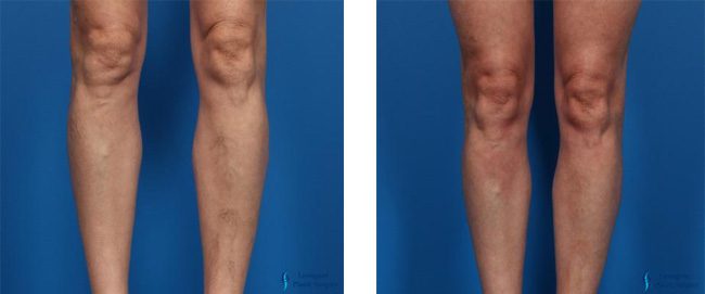 Injectable Fillers