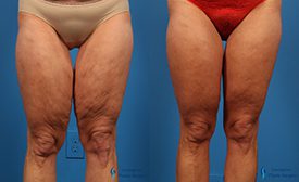 Thigh Lift Thigh Lift