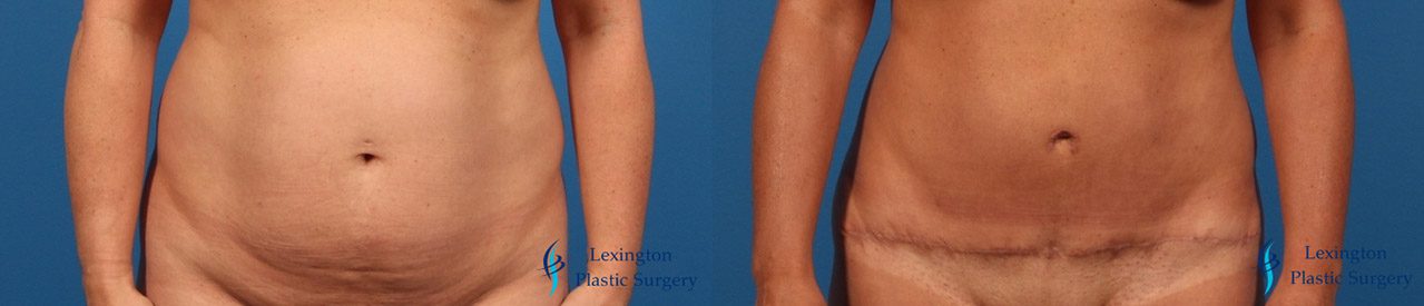 Tummy Tuck
