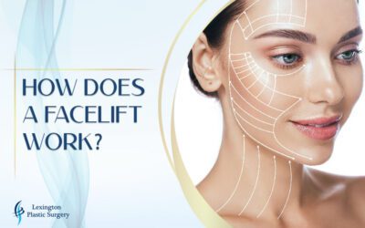 How Does a Facelift Work? How Does a Facelift Work?