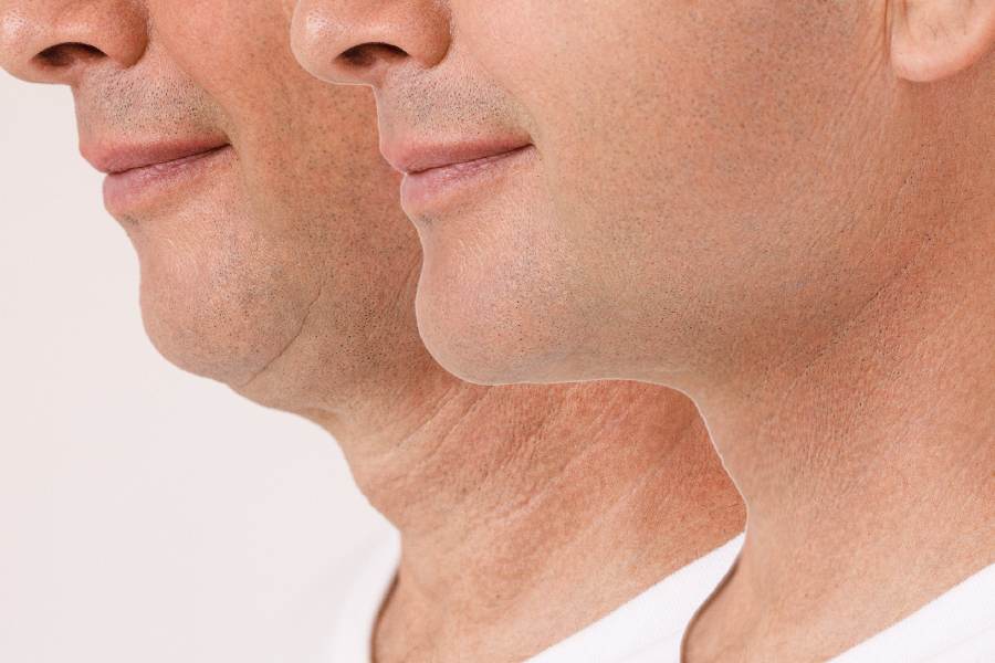 Reasons Why Men Undergo Neck Lift Procedures Reasons Why Men Undergo Neck Lift Procedures
