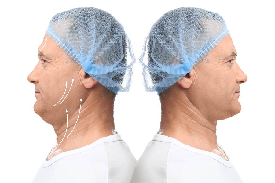 What to Expect Before, During, and After a Neck Lift Procedure What to Expect Before, During, and After a Neck Lift Procedure
