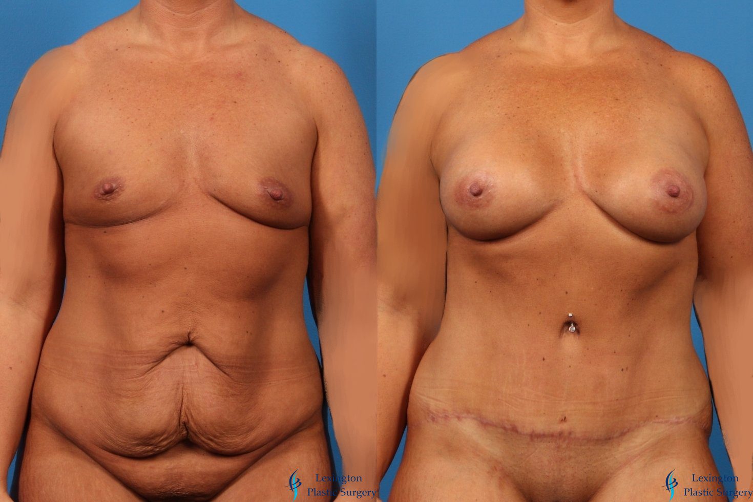 Abdominoplasty + Breast Augmentation 003 Breast Augmentation: Patient 13