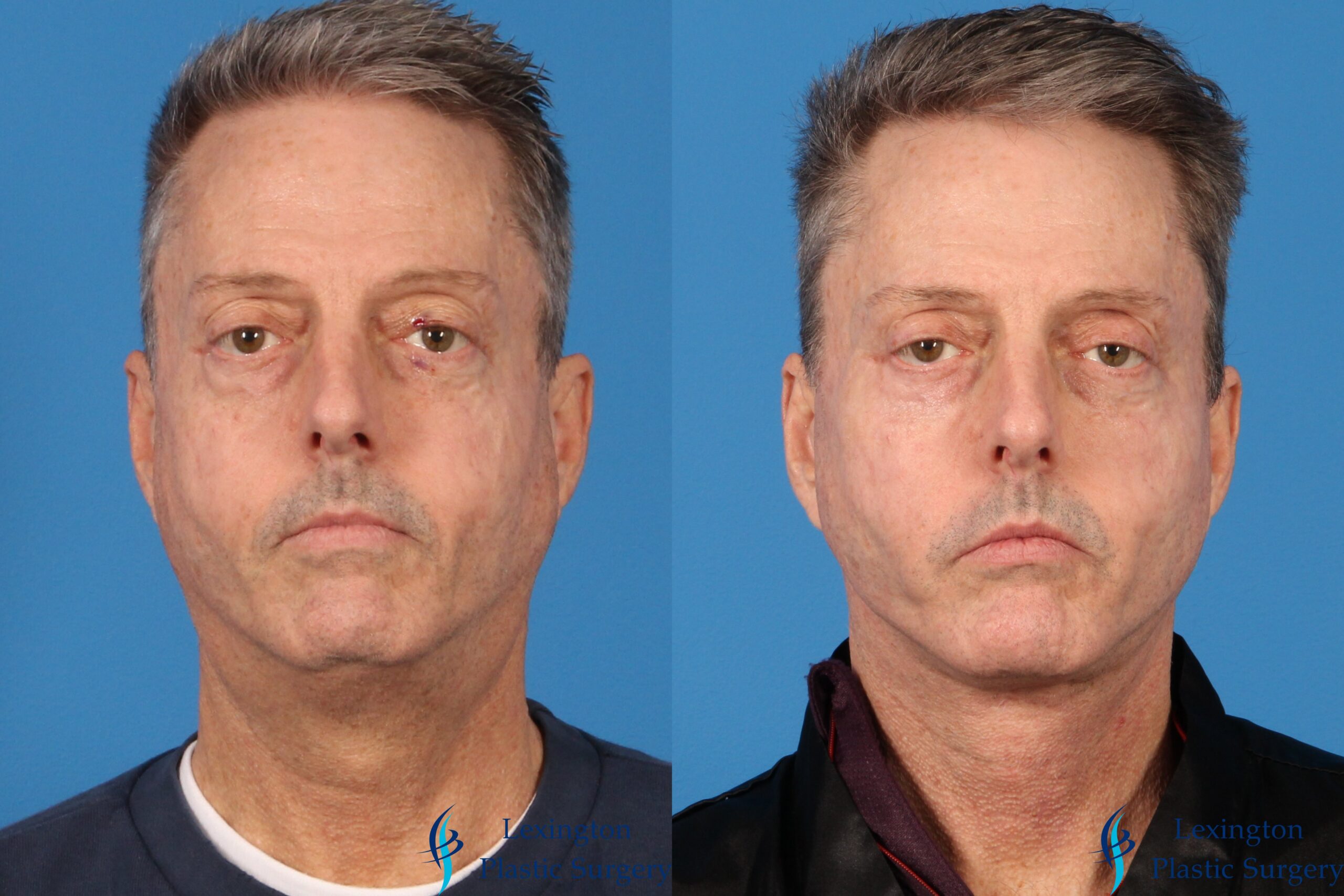 Facelift & Neck Lift: Patient 7