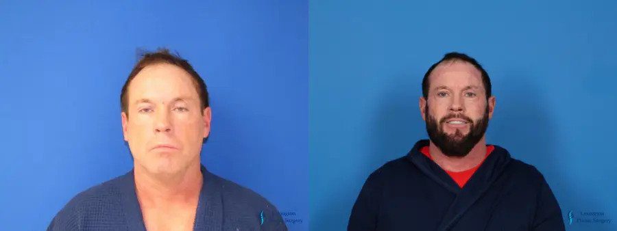 Facelift & Neck Lift: Patient 7