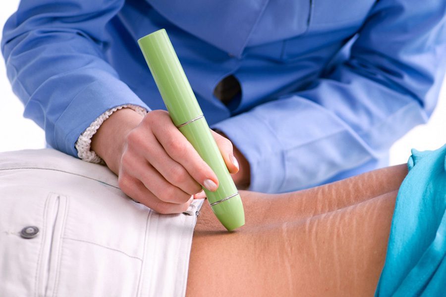 Benefits and Considerations of Scar Revision Benefits and Considerations of Scar Revision