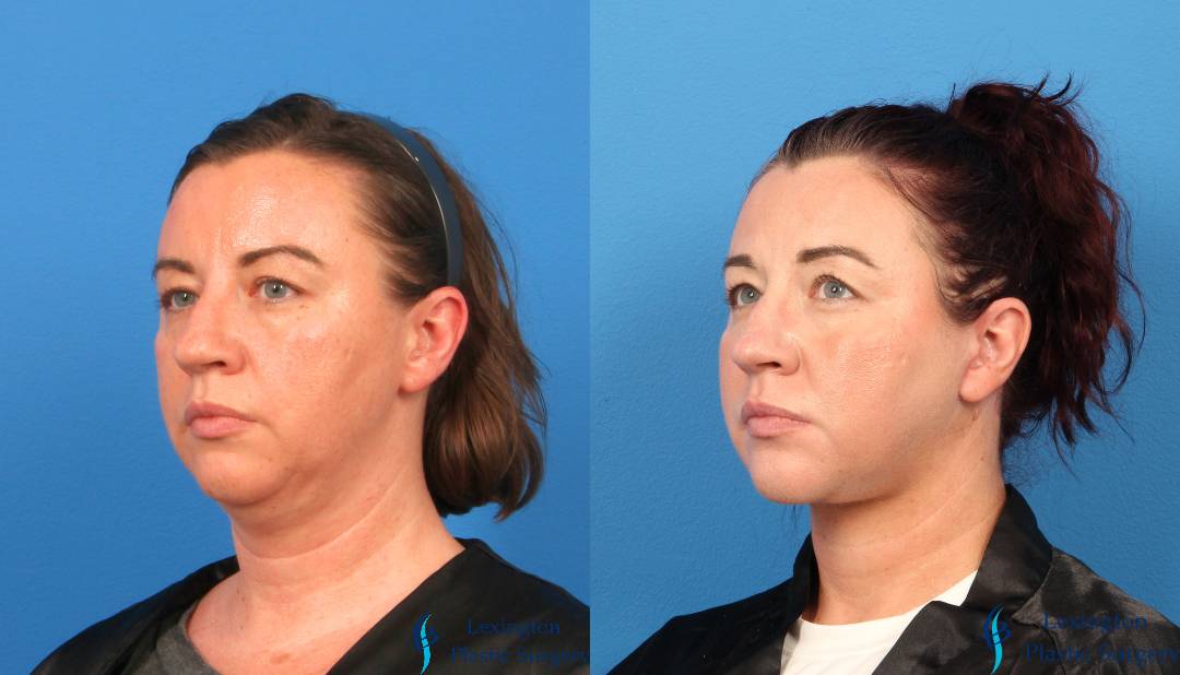 Necklift Pt. 5 Neck Lift: Patient 1